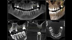 An Example of Dental CT Scan