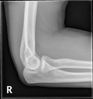 An Example of Elbow X-ray