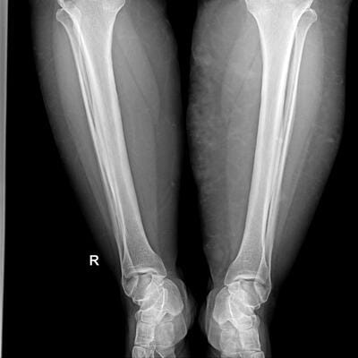 An Example of Leg X-ray