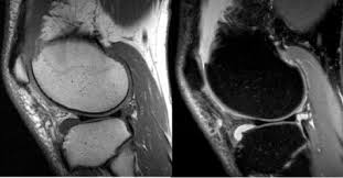 An Example of Musculoskeletal MRI