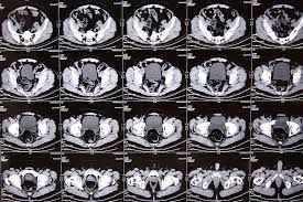 An Example of Detailed Pelvis CT Scan