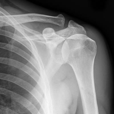 An Example of Shoulder X-ray
