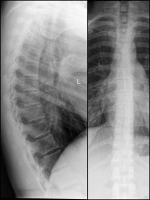 An Example of thoracic Spine X-ray