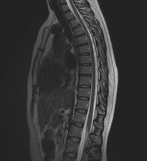An Example of Thoracic Spine MRI