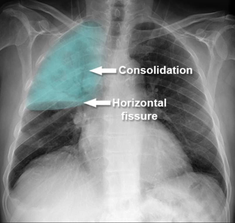 An abnormal chest X-ray showing areas of consolidation typical of pneumonia