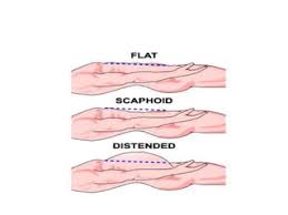 Understanding The Scaphoid Abdomen