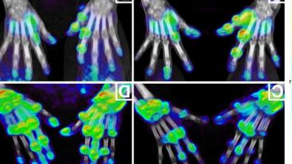 PET scans predict arthritis treatment success PET scans predict arthritis treatment success - arthritis treatment