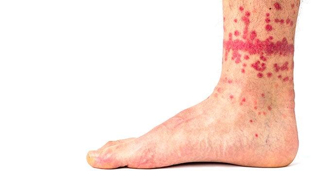 Flea Infestation FAQ