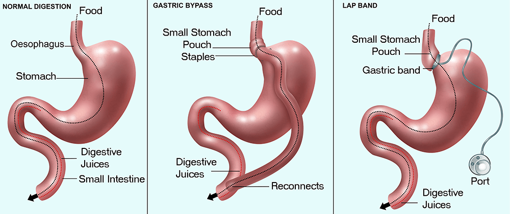 Navigating Weight Loss: A Comprehensive Guide to Bariatric Surgery Perth