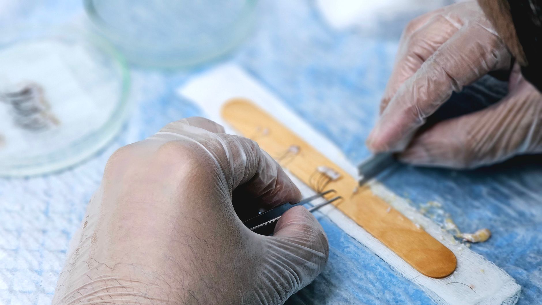 Understanding the basics of hair transplant surgery