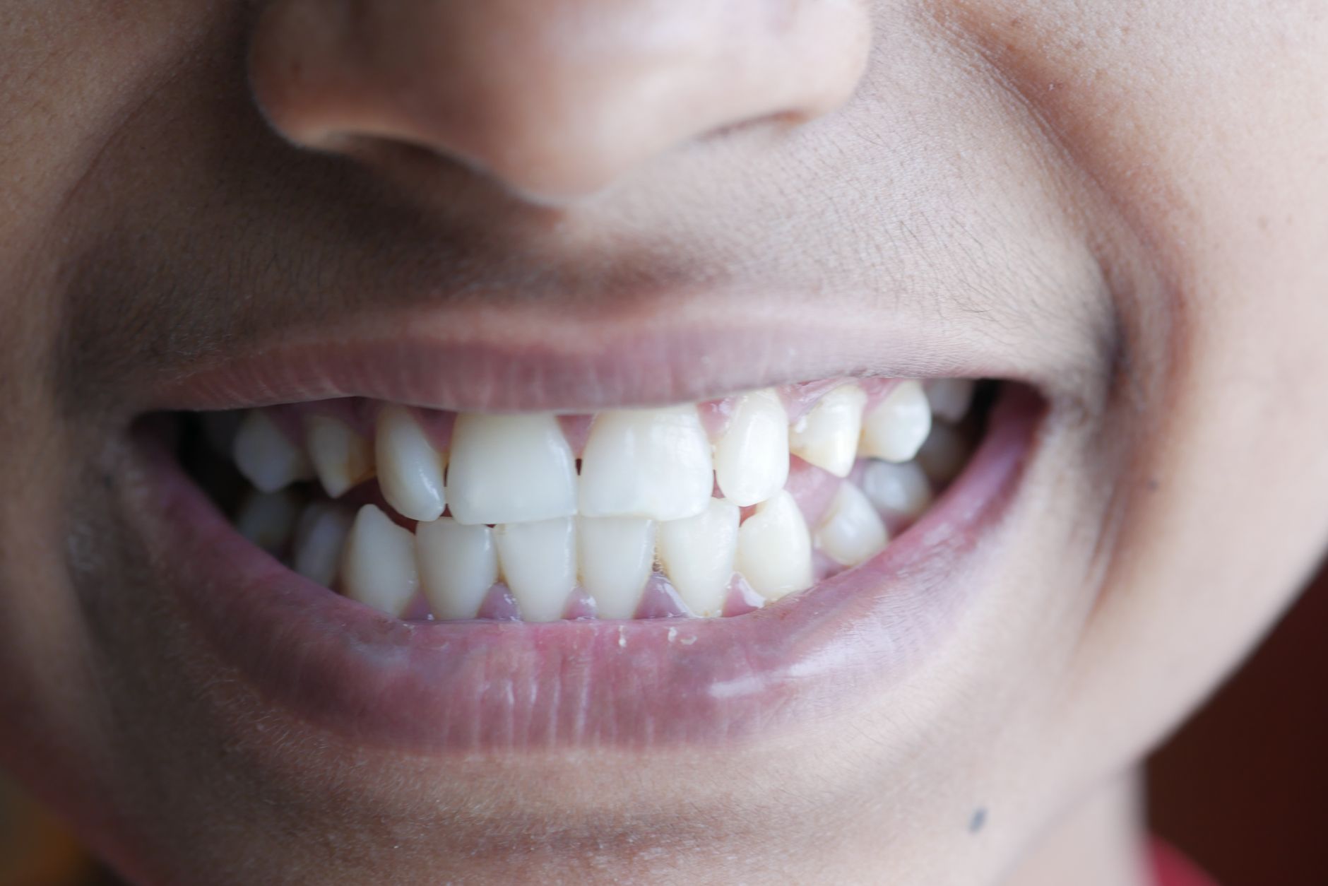Types of Vitamins that Are Effective in Overcoming Gum and Tooth Infections