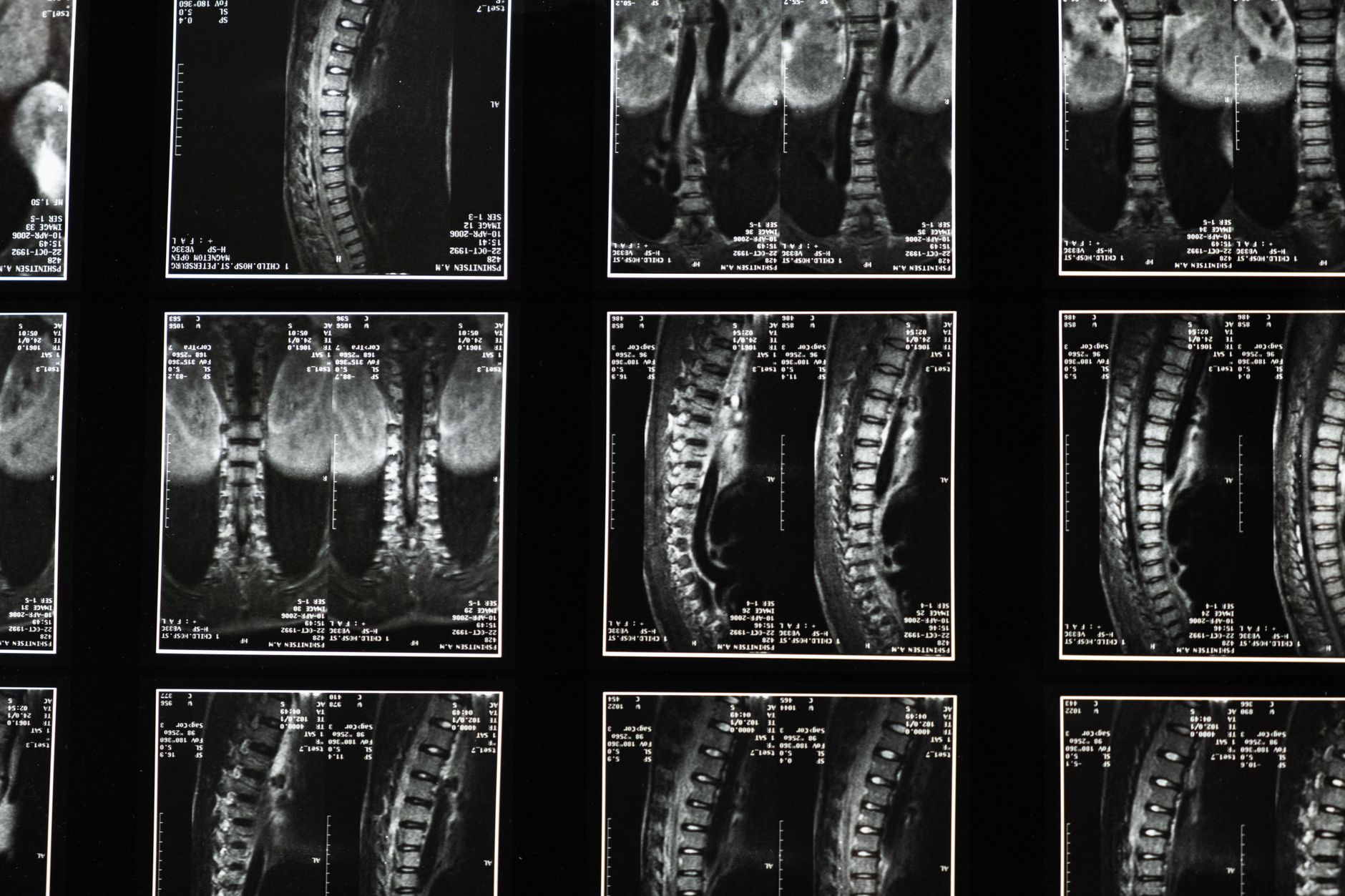 BPD Treatment with Brain Scan: Uncovering Pathways to Healing