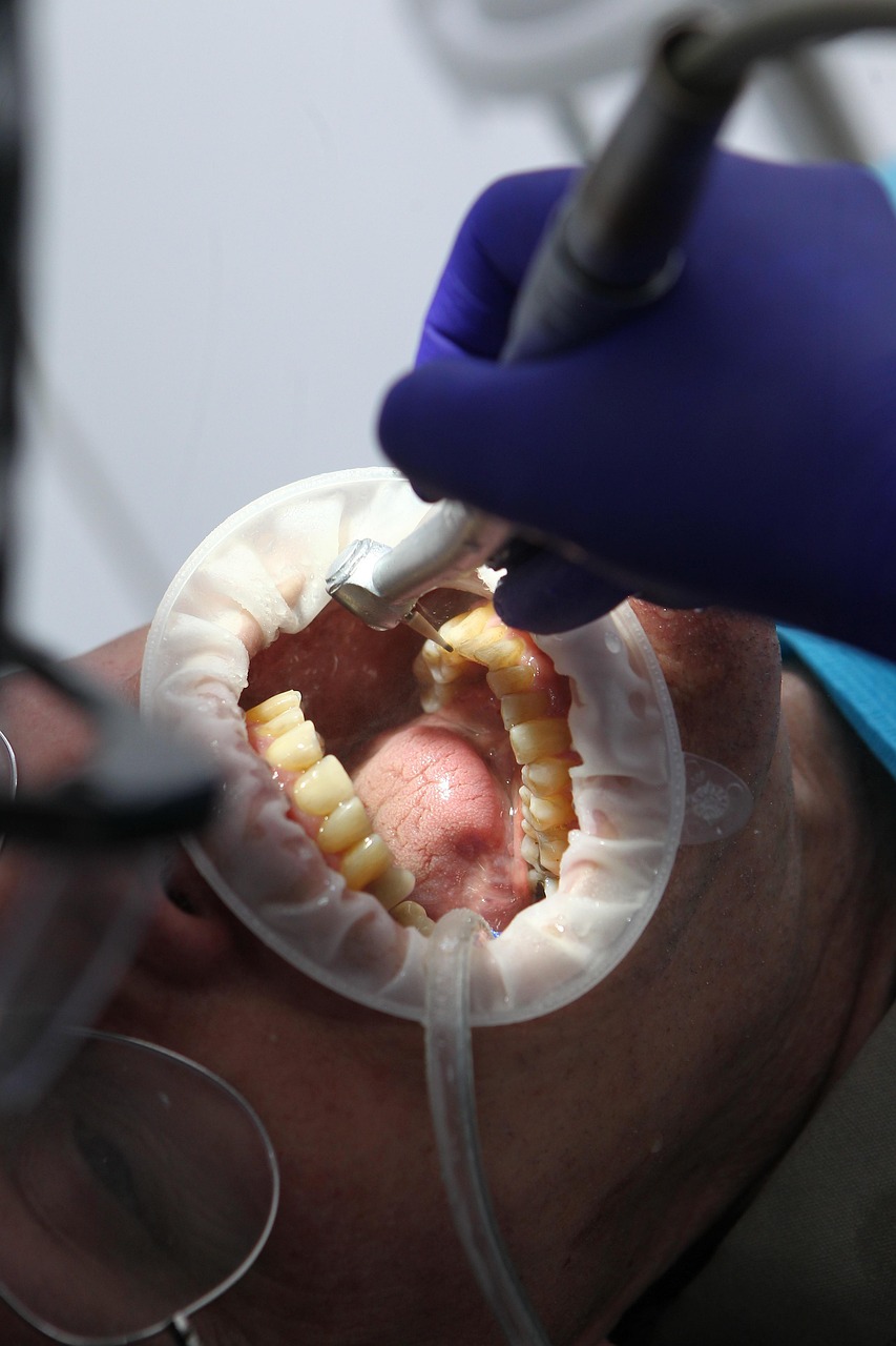 The Impact of Sugar on Oral Health in Poway, CA
