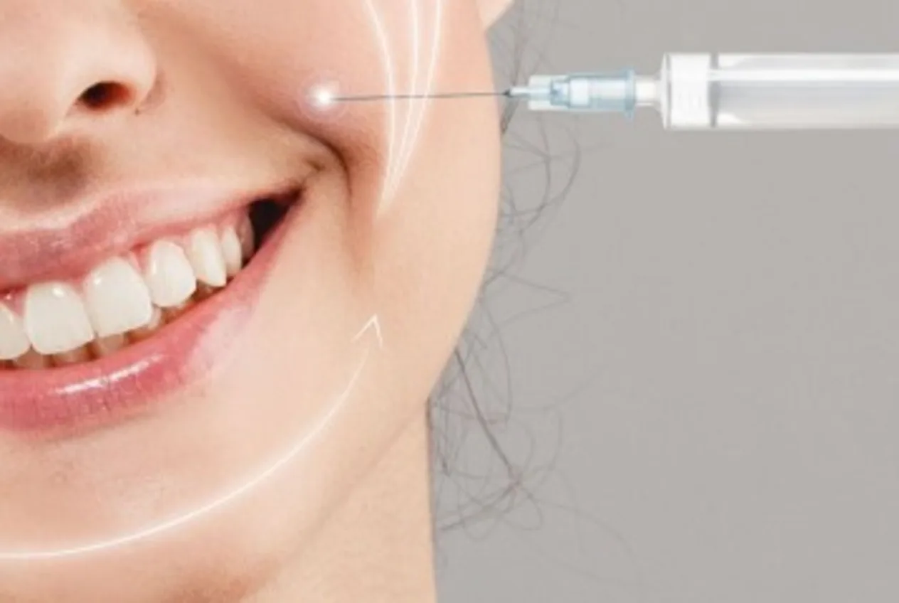تزریق فیلر برای خط خنده؛ بهترین راهکار کدام است؟