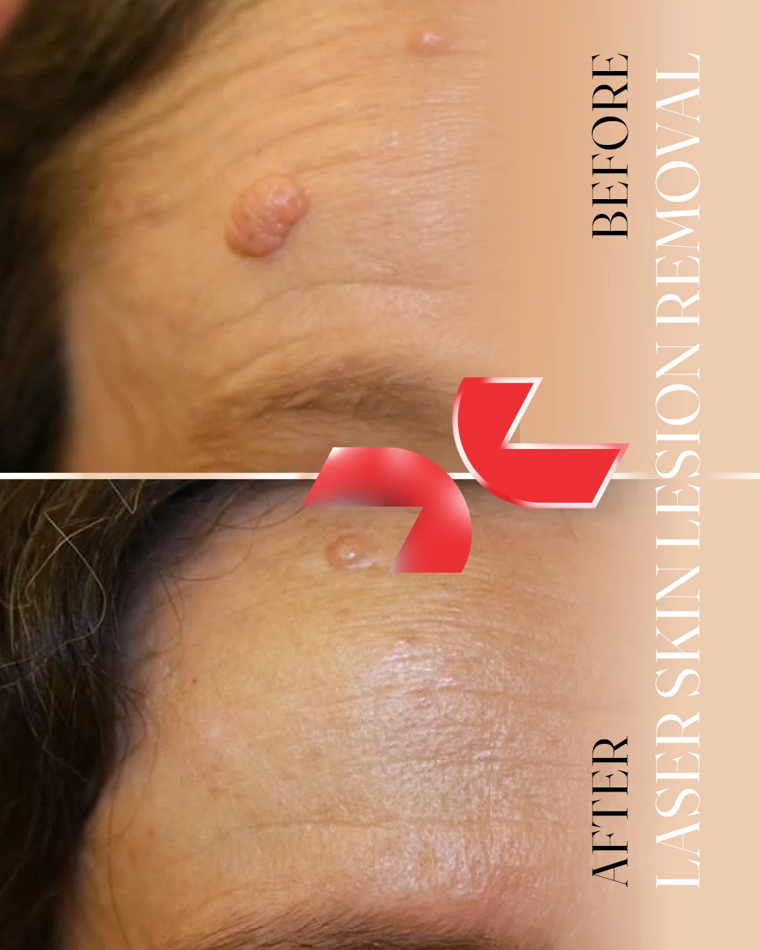 لیزر Dermablate آلمان - Image