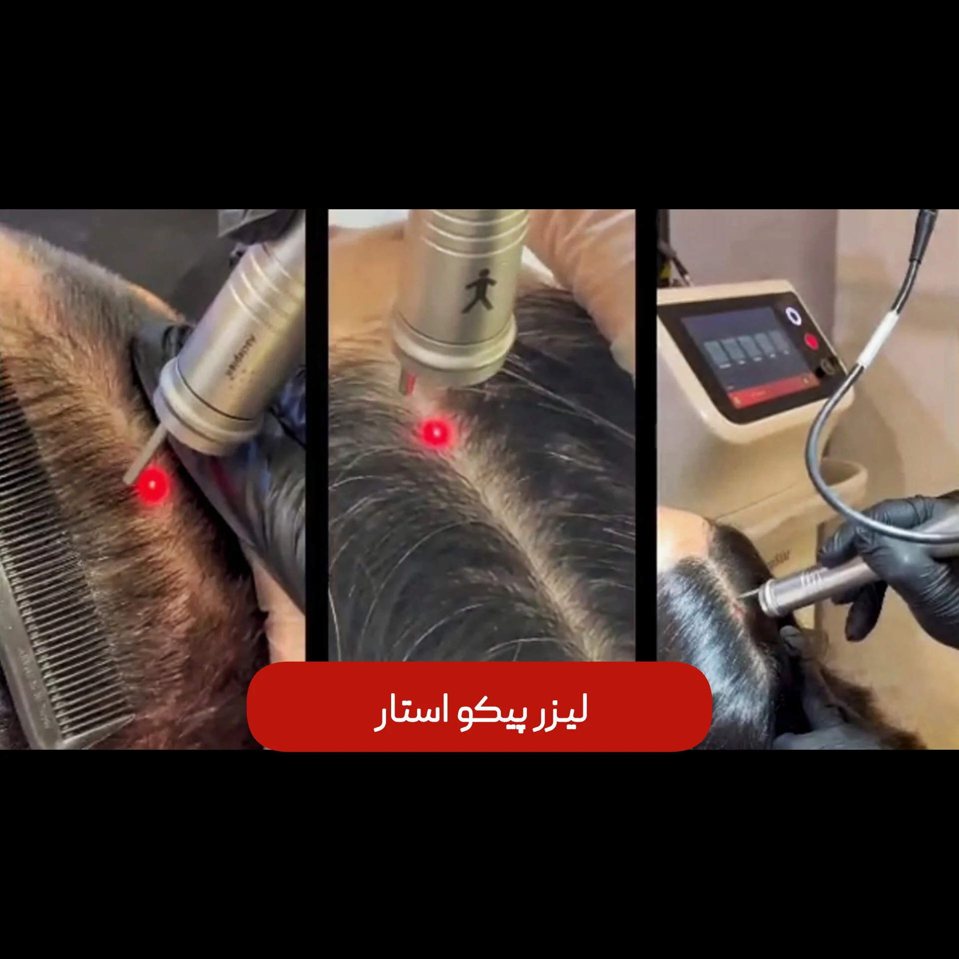 لیزر Pico Star آلمان - Image