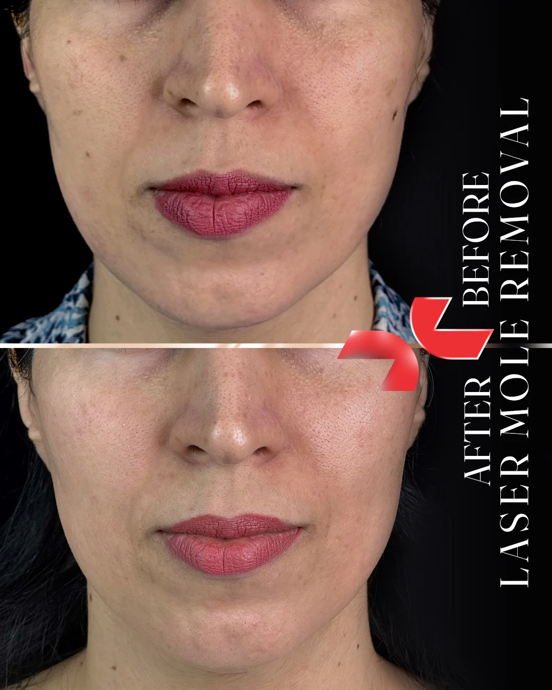 لیزر Dermablate آلمان - Image
