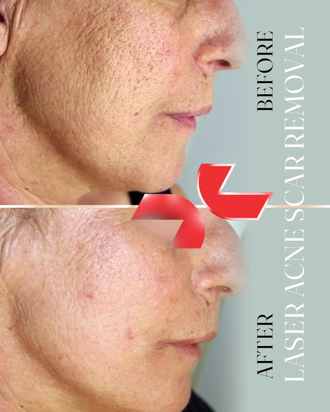 لیزر Dermablate آلمان - Image