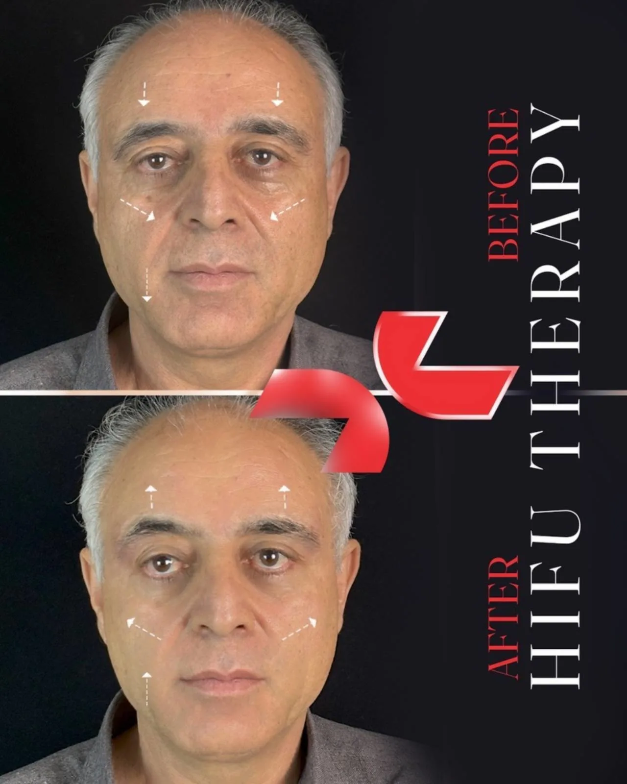 بوتاکس - Image