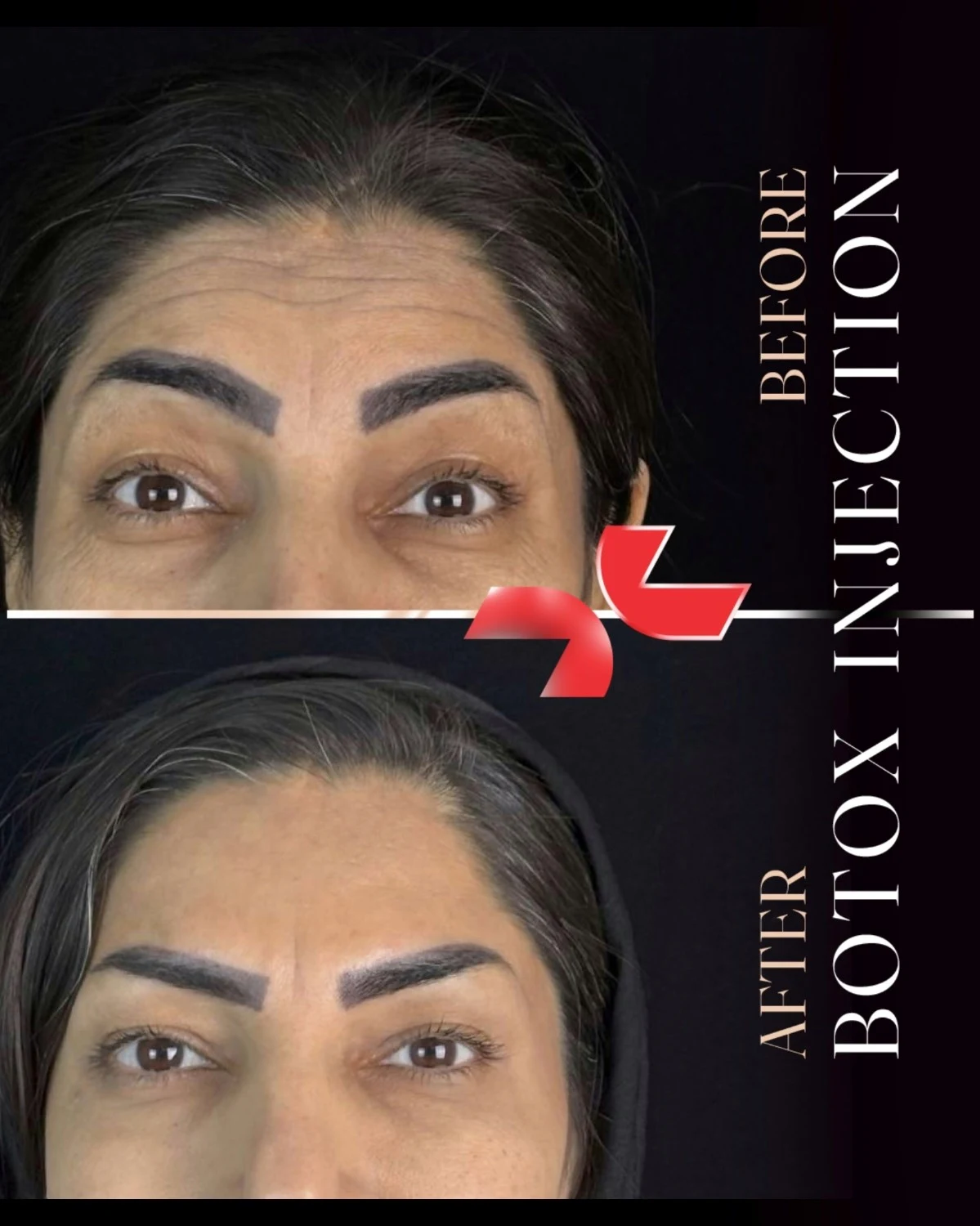 بوتاکس - Image