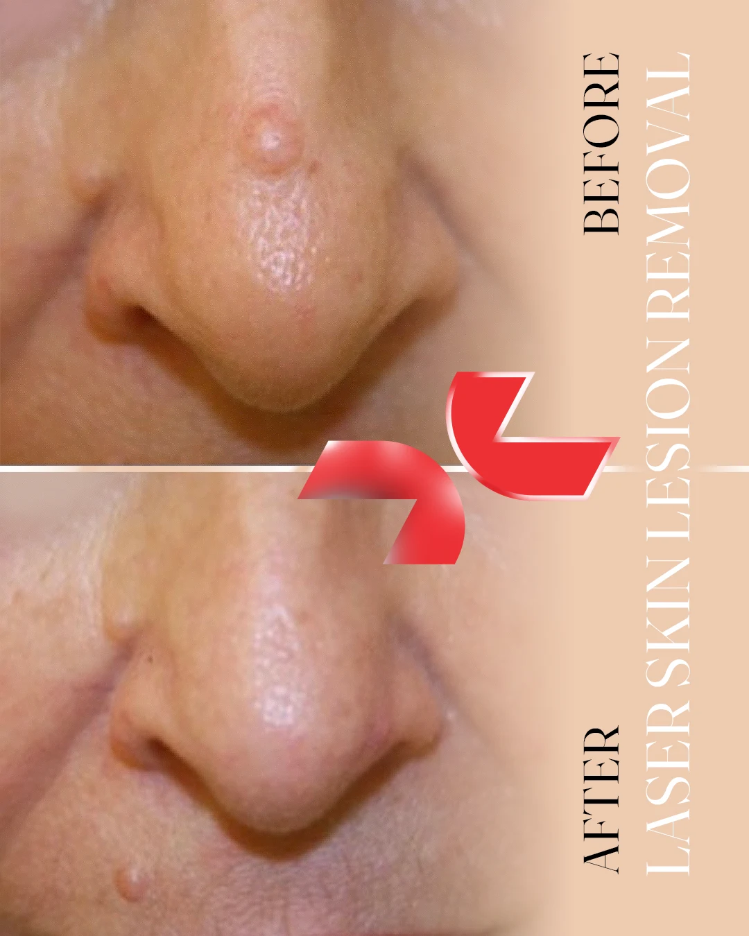 لیزر Dermablate آلمان - Image