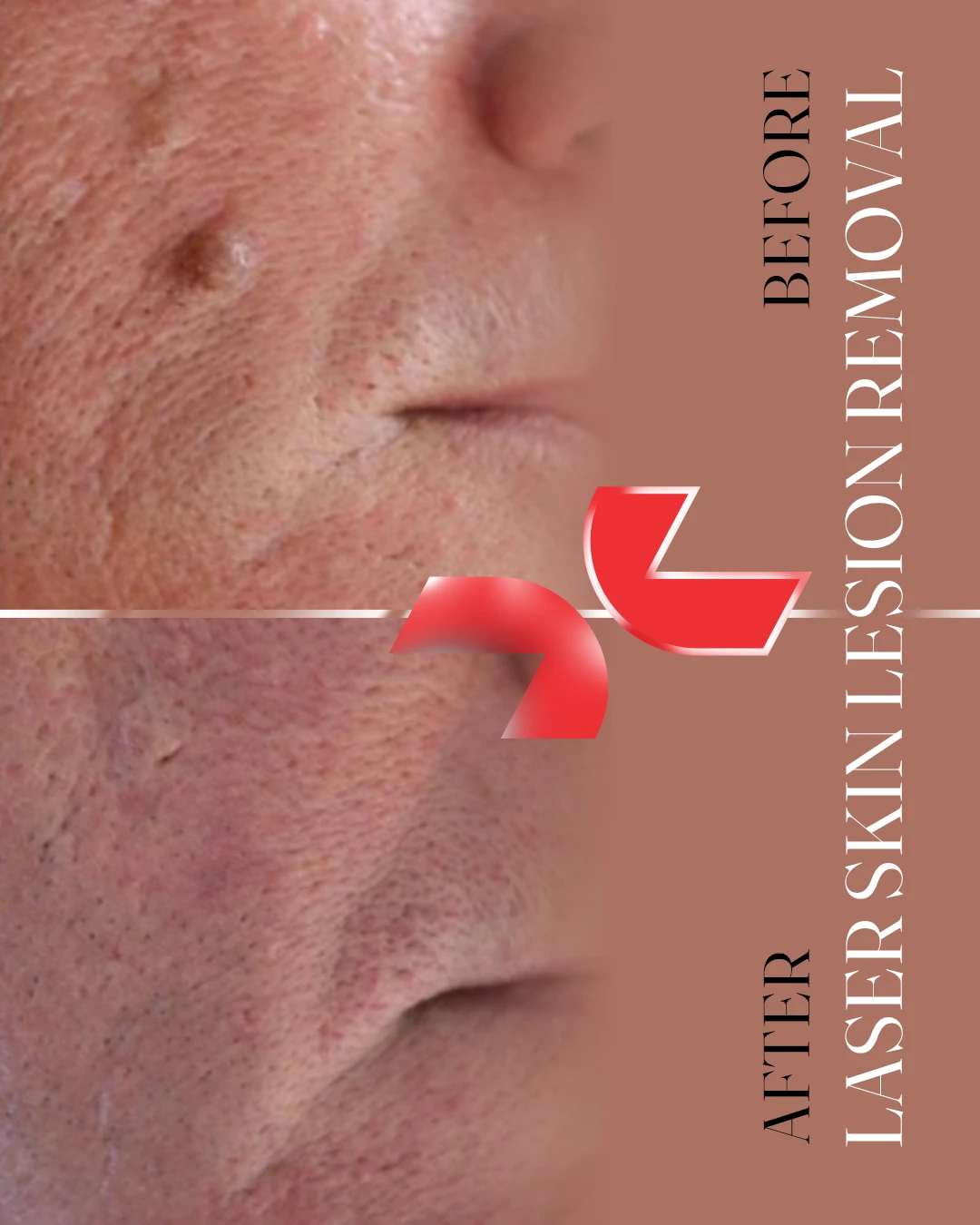 لیزر Dermablate آلمان - Image