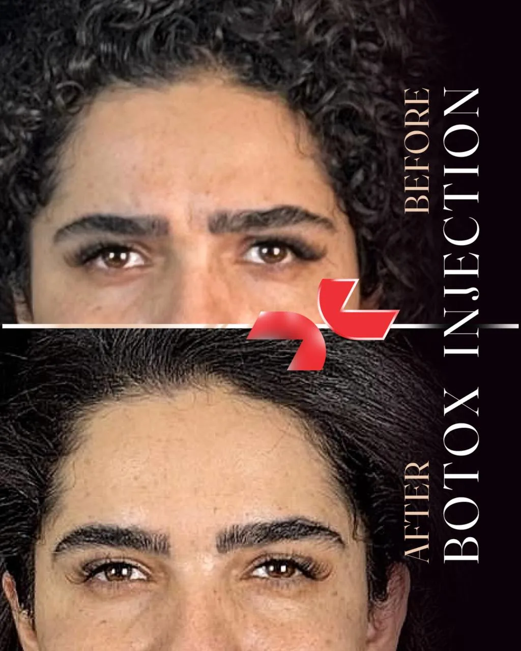 بوتاکس - Image