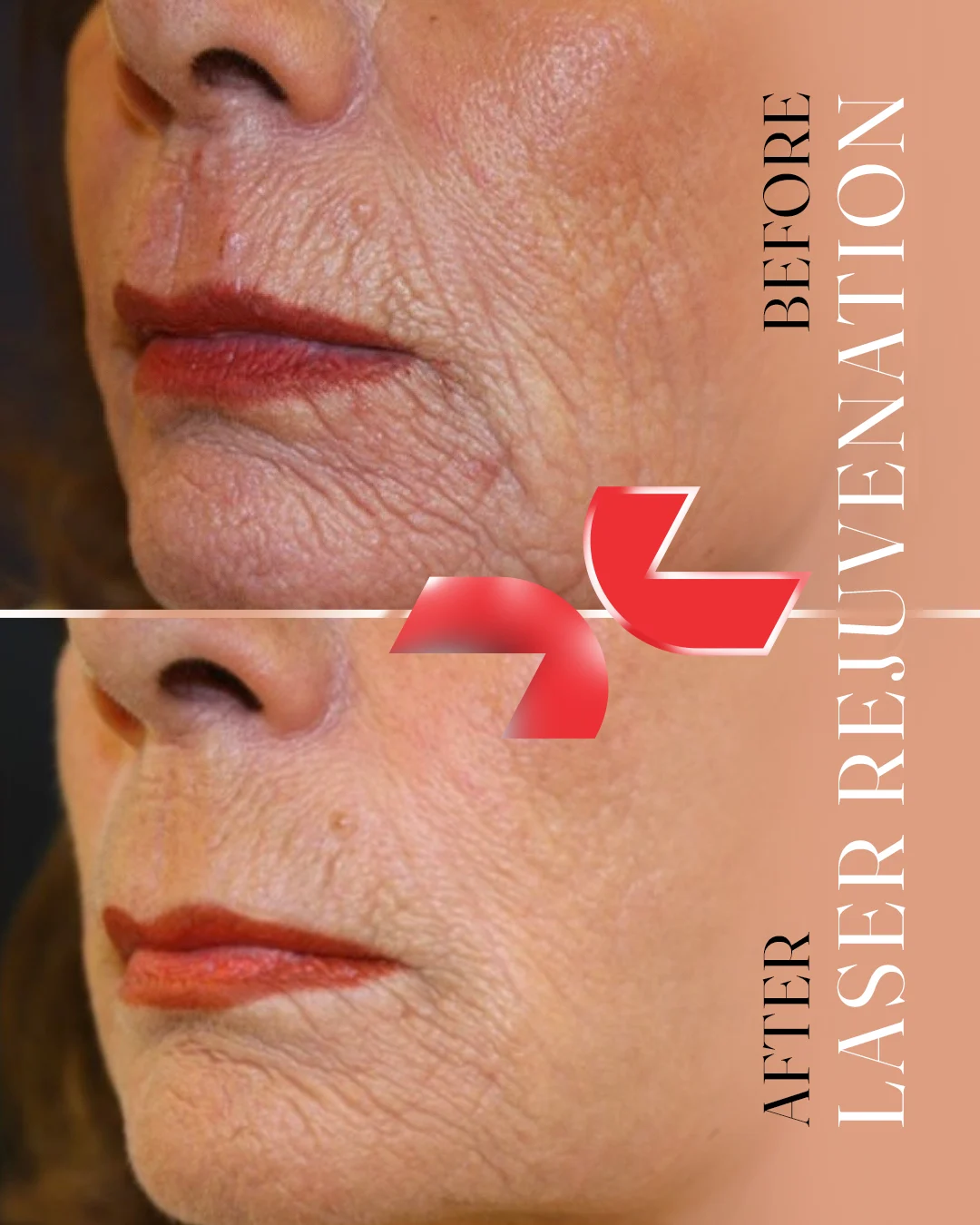 لیزر Dermablate آلمان - Image