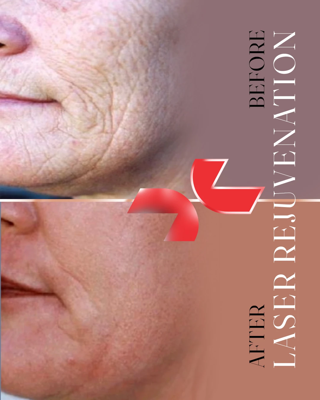 لیزر Dermablate آلمان - Image