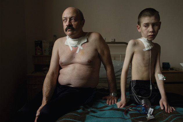 Suffering from thyroid cancer, Oleg Shapiro, 54, and Dima Bogdanovich, 13, receive care at a thyroid hospital in Minsk, where surgery is performed daily. Belarus, 2005. © Gerd Ludwig.