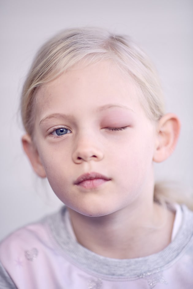 Lucinda with stung eye, 2016. Photo by Jon Reid. Finalist, National Photographic Portrait Prize 2017.
