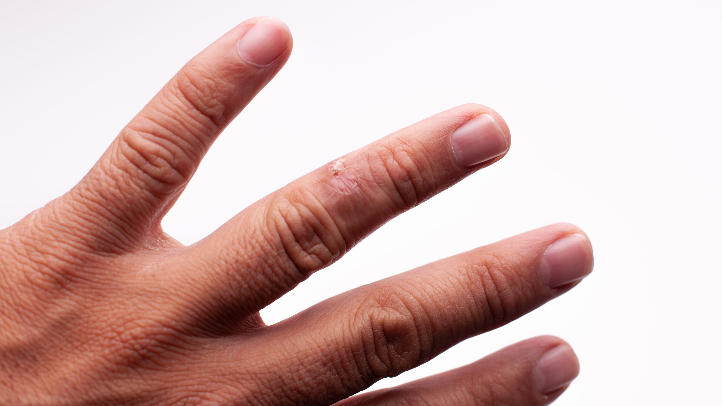 Four Things To Know About Scleroderma | Yale School of Medicine