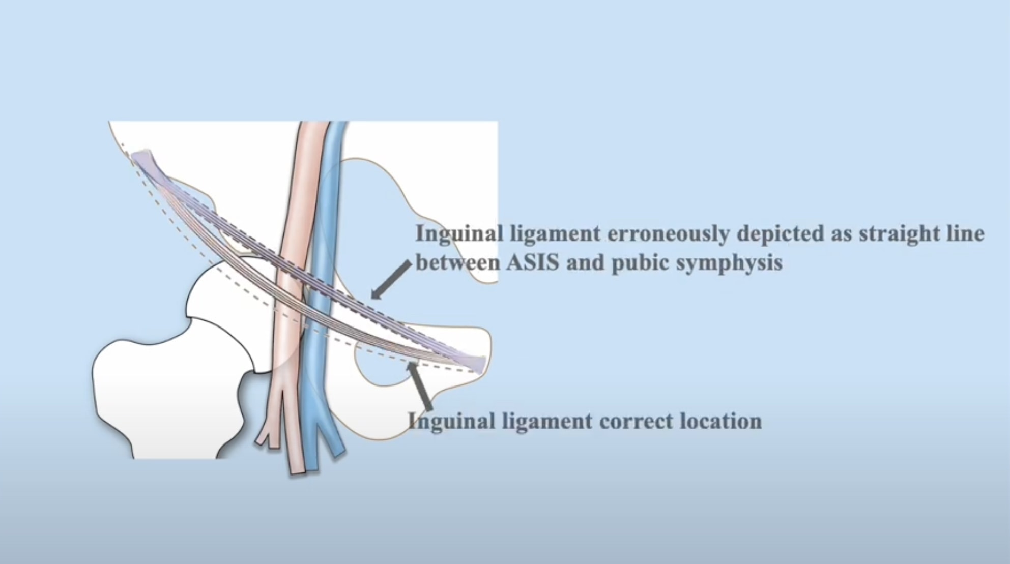 New Instructional Video on Optimal Femoral Access Corrects Anatomical Error