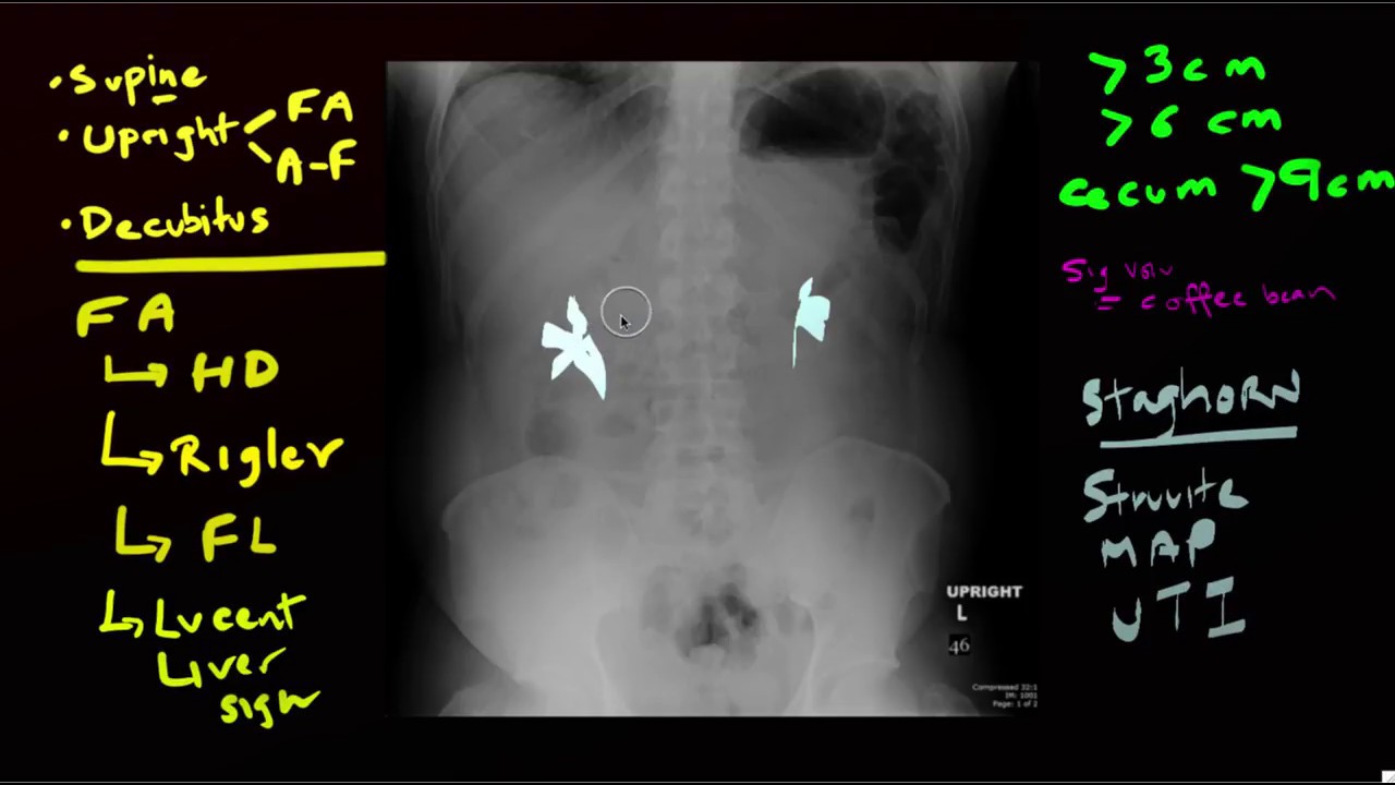 Abdominal XRAYS