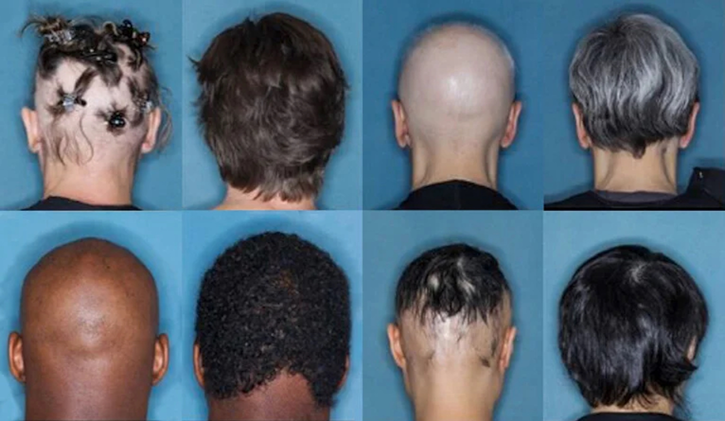 Changing the Lives of Patients With Alopecia and Vitiligo