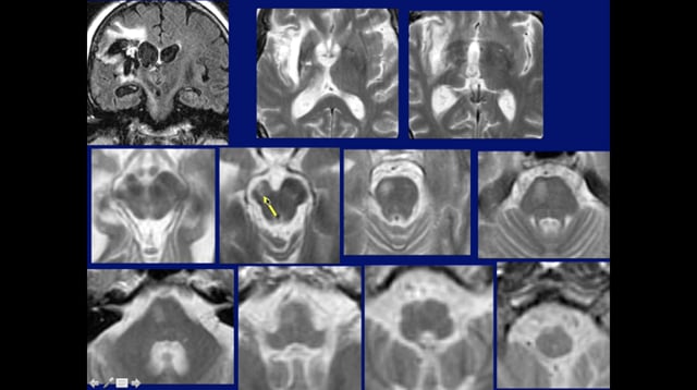 Imaging The Brainstem Tracts Part 1 Aug 5 2015