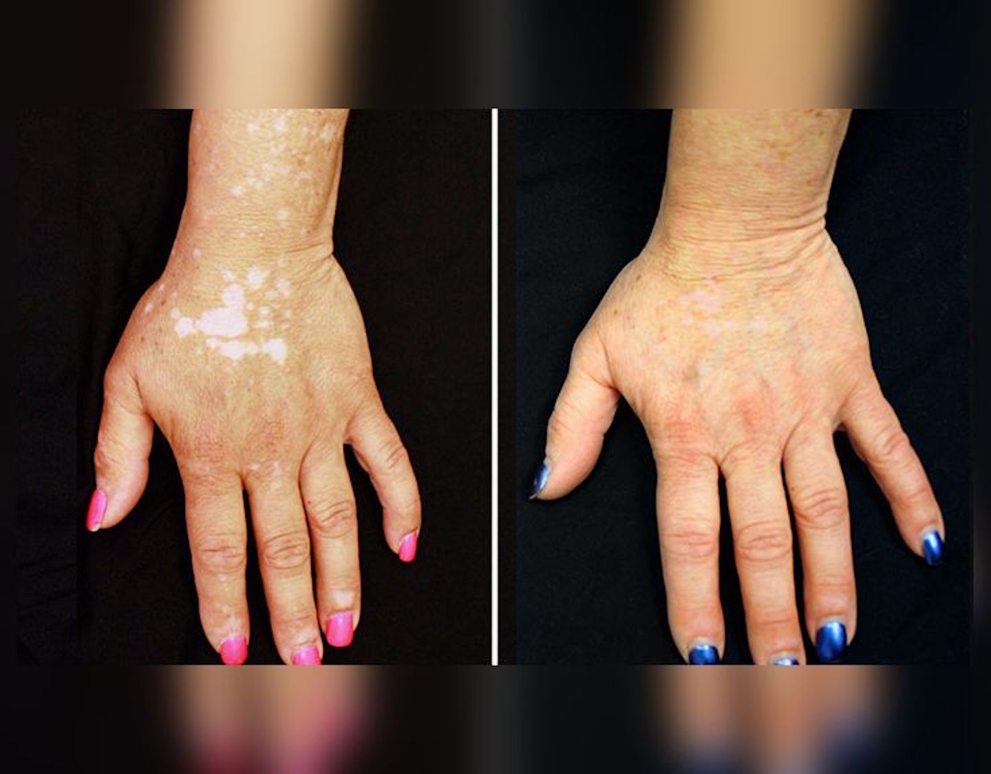 Changing the Lives of Patients With Alopecia and Vitiligo