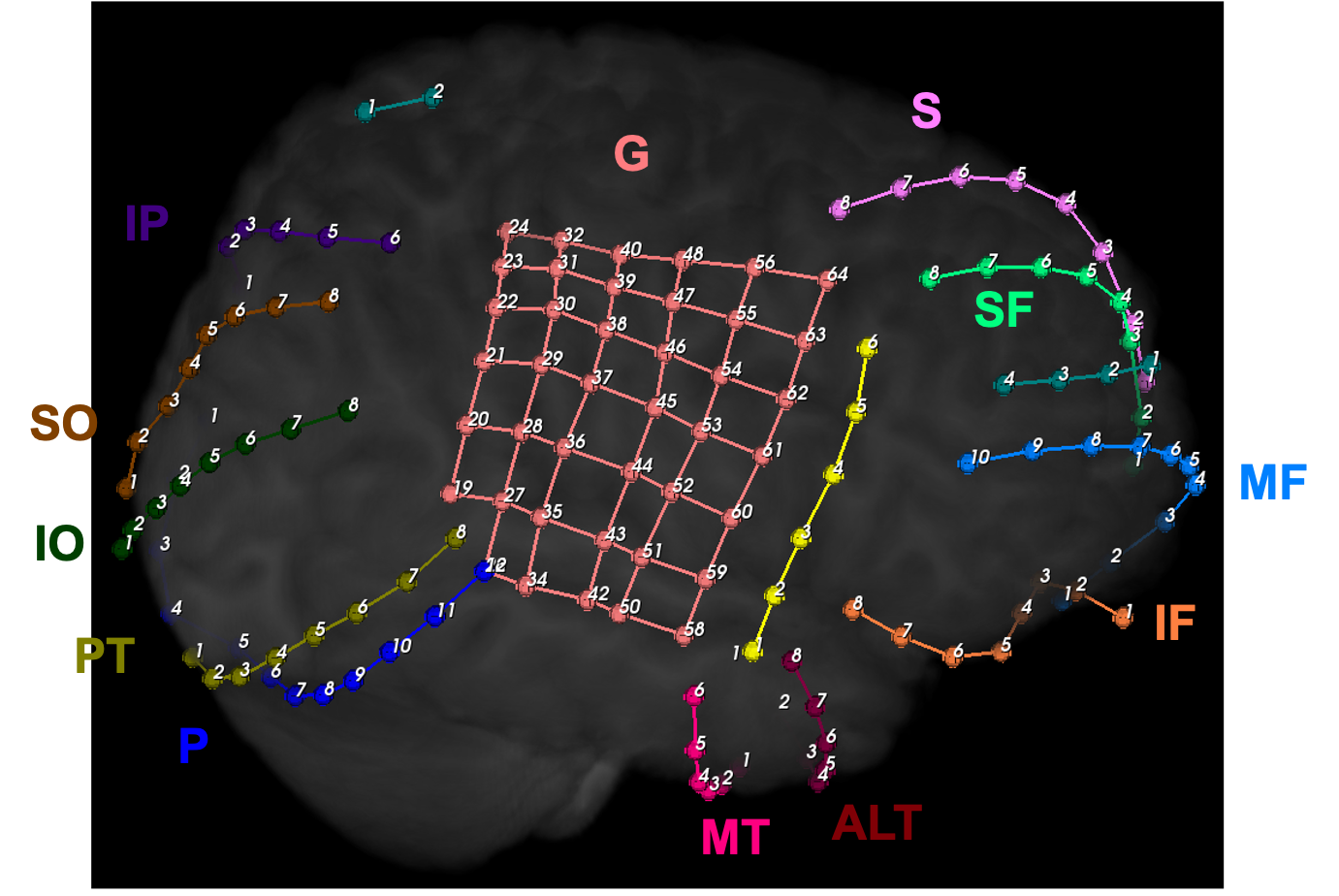 Yale Surgeons Develop New Techniques in Epilepsy Surgery