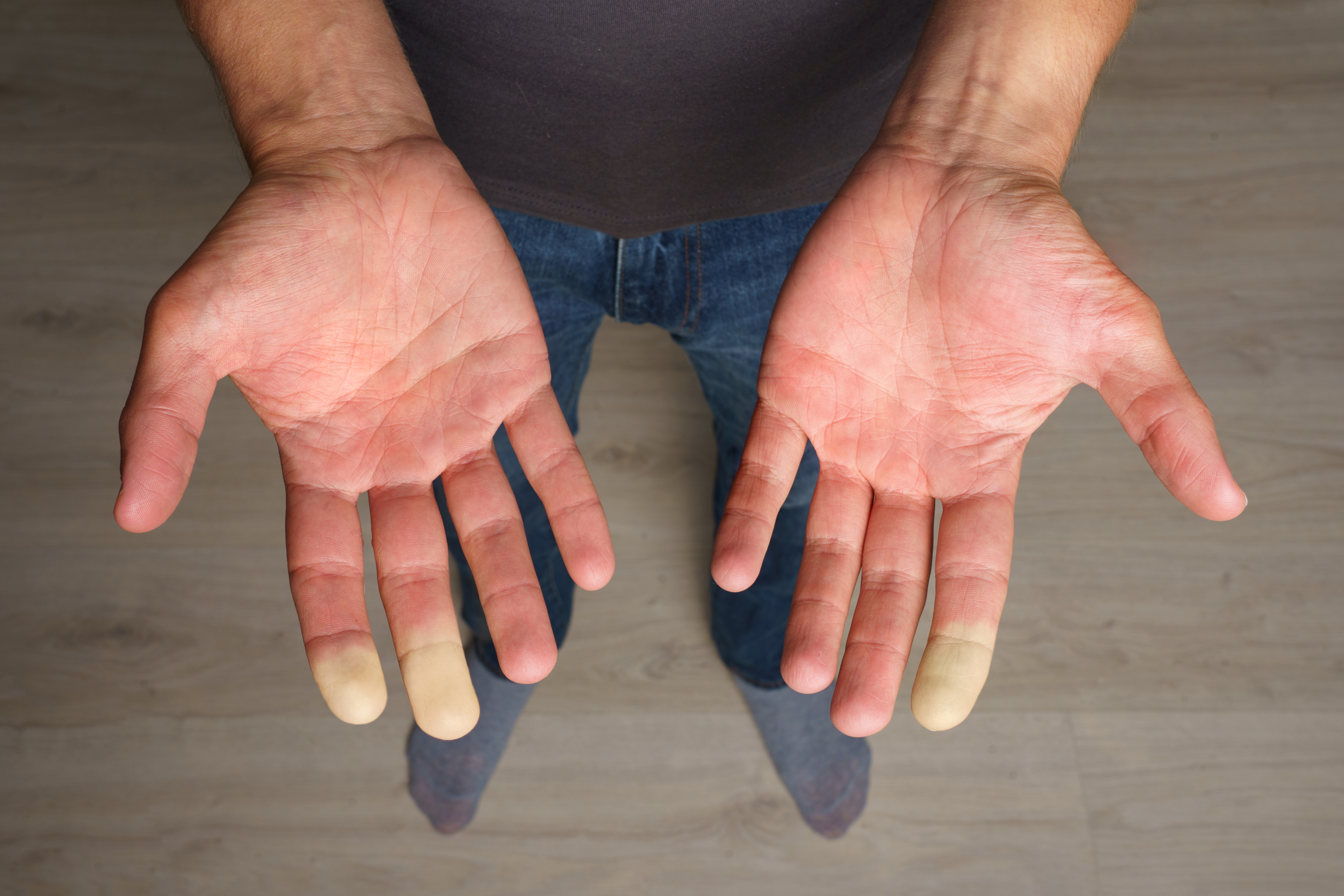 New Outpatient Raynaud Treatment Saves Fingers and Toes < Yale