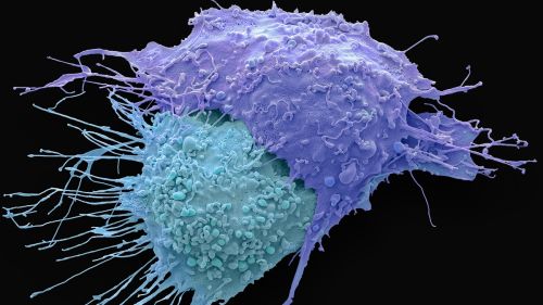 A coloured scanning electron micrograph of ovarian cancer cells