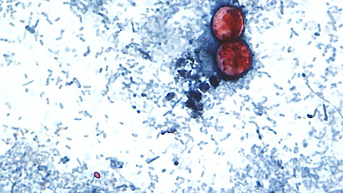 Michigan probes lettuce as cyclospora cases hit record - cyclospora outbreak