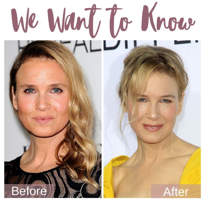 We Want To Know Renee Zellweger S Eyes Prejuvenation