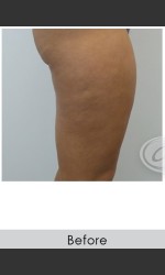 VanquishME with Cellutone Treatment Physician - Prejuvenation before & after