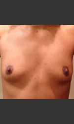 Dr. Palmer Breast Augmentation 02 Physician- Prejuvenation before & after