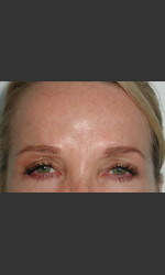 Serene Procedure (Nuebelle) Physician - Prejuvenation Before & After
