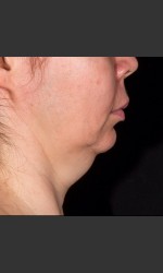 SculpSure Submental Physician - Prejuvenation before & after