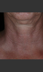 Alastin Skincare Restorative Neck Complex with TriHex Technology® Physician- Prejuvenation before & after