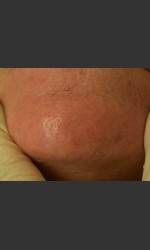 Cutera Laser Treatment Physician - Prejuvenation Before & After