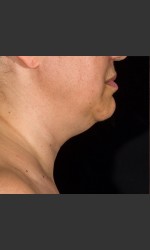 SculpSure Submental Physician - Prejuvenation before & after