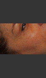 Dr. Palmer Vein Removal 01 Physician- Prejuvenation Before & After
